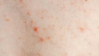 How to Prevent the Itchy Hives?